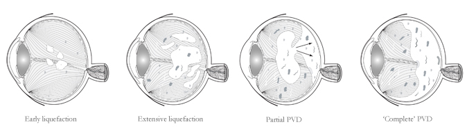 The age-related emergence of eye floaters by liquefaction and posterior vitreous detachment.