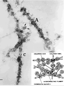 Microscopic picture and schematic of the ultrastructure of vitreous collagen-hyaluronan fibers.